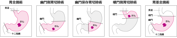 図2：胃切除術