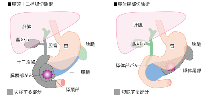 膵臓がんの代表的な切除術