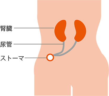 図1　尿管皮膚瘻の完成図