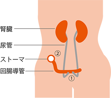 図2　回腸導管の完成図