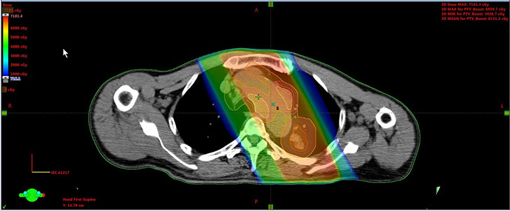 肺がんへの3次元放射線治療の治療計画