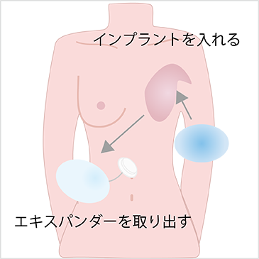 人工物法（乳房インプラント）3