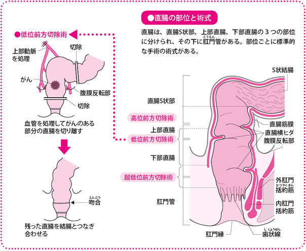 直腸の部位と術式