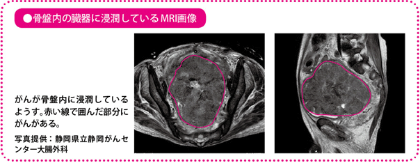 骨盤内の臓器に浸潤しているMRI画像