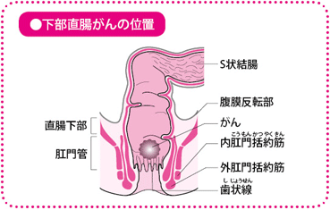 下部直腸がんの位置