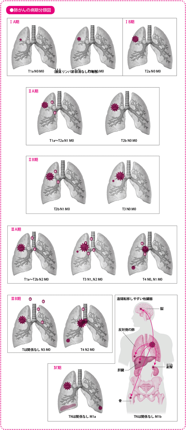 肺がんの病期分類図