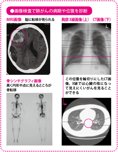 画像検査で肺がんの病期や位置を診断