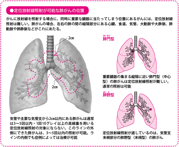 定位放射線照射が可能な肺がんの位置