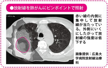 放射線を肺がんにピンポイントで照射