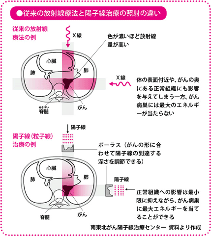 従来の放射線療法と陽子線治療の照射の違い