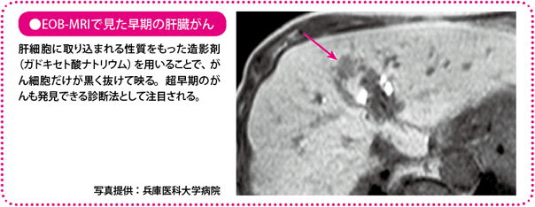 EOB-MRIで見た早期の肝臓がん