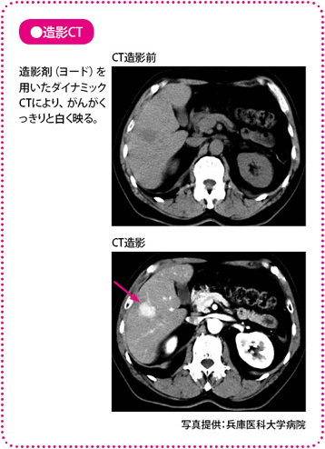 肝臓がん、治療法選択のための診断法と検査 – がんプラス