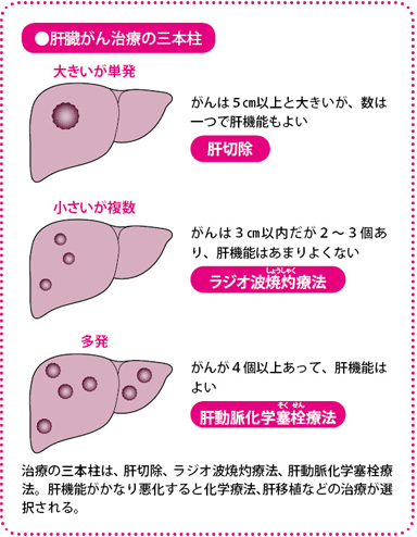肝臓ガン治療の三本柱