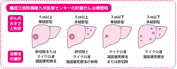 国立病院機構九州医療センターの肝臓がん治療戦略
