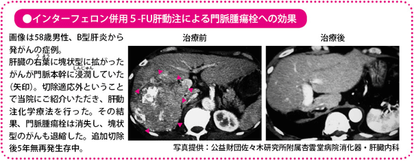 インターフェロン併用5-Fu肝動注による門派腫瘍栓への効果