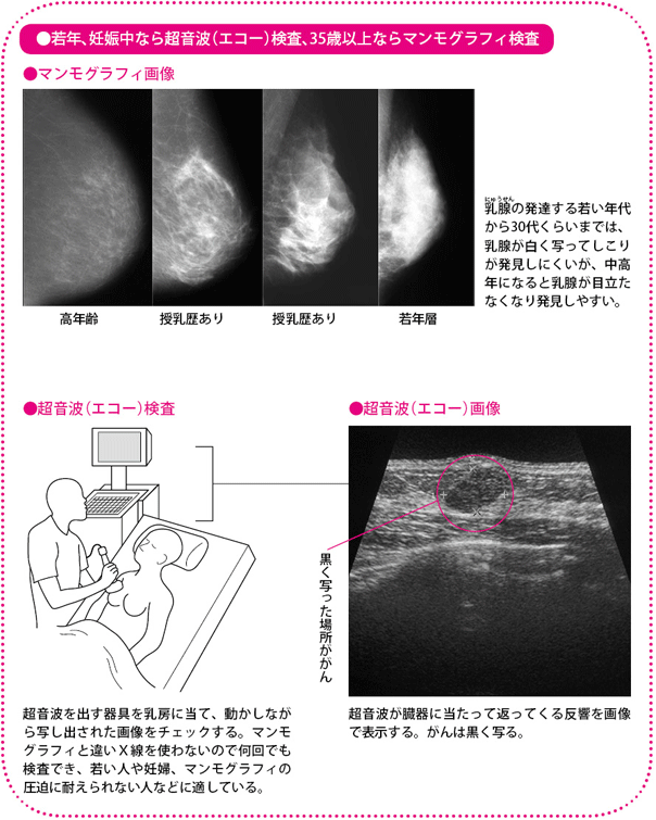 若年、妊娠中なら超音波（エコー）検査、35歳以上ならマンモグラフィ検査