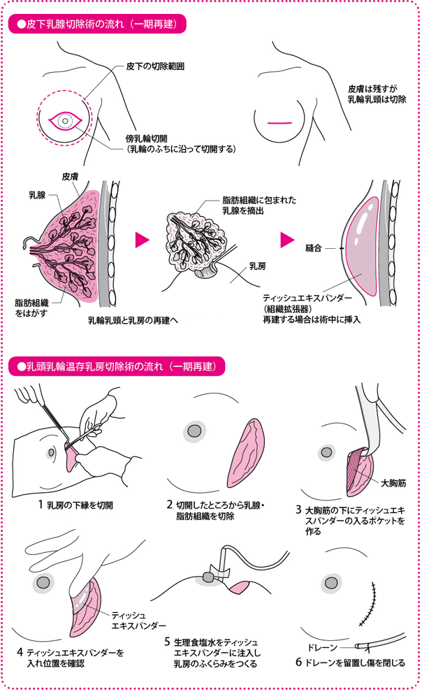 皮下乳腺切除術の流れ（一期再建）