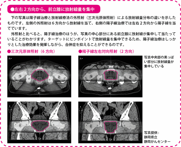 左右2方向から、前立腺に放射線量を集中