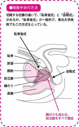 開腹手術の方法