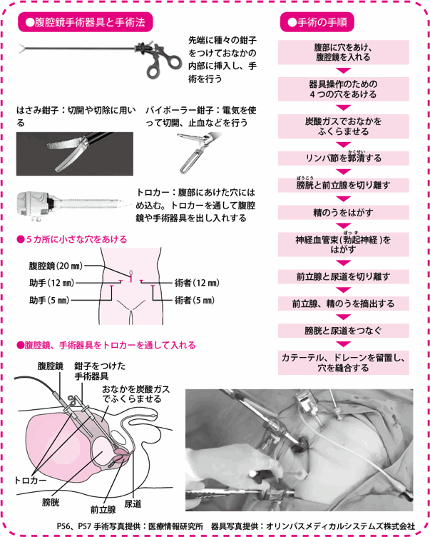 手術の手順・腹腔鏡手術器具と手術法